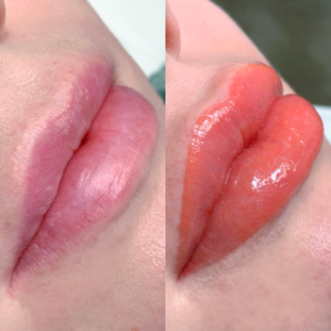 Lip Blush Tattoo vs. Lip Fillers - Choosing the Perfect Look for You