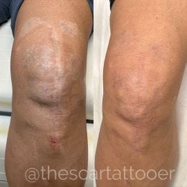 What is a Scar Revision Treatment?