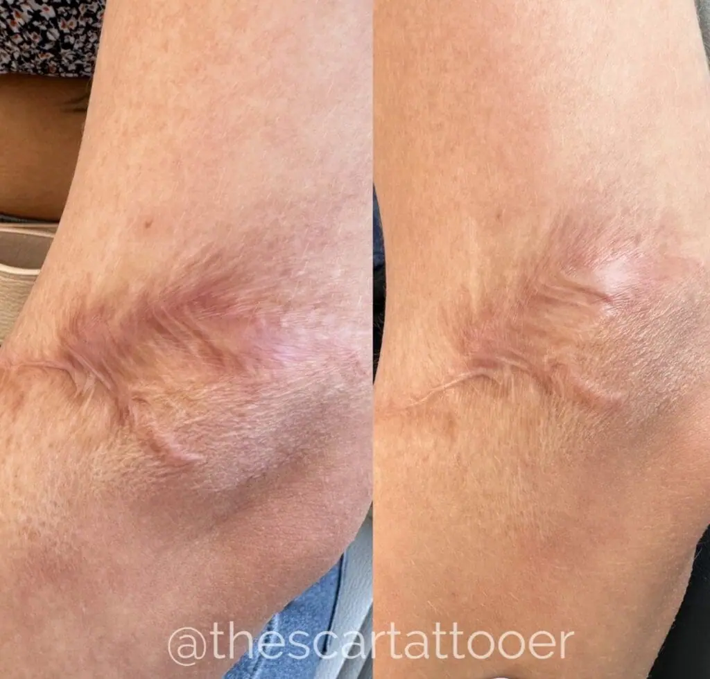 Scar camouflage * Extraordinarily effective and very safe, our treatments  can improve the appearanc… | Tattoos to cover scars, Best eyebrow products, Scar  tattoo