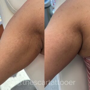 Stretch mark Camouflage Treatments