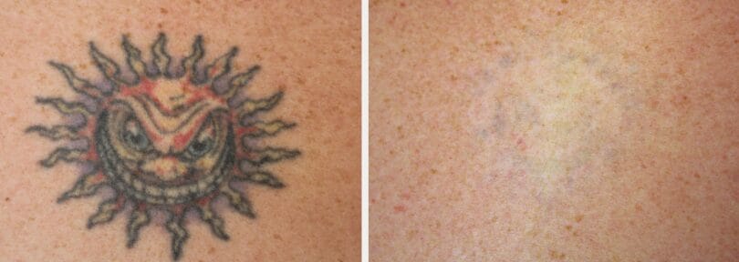 Laser Tattoo Removal