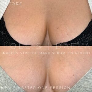 Inkless Scar Camo at DAELA Cosmetic Tattoo