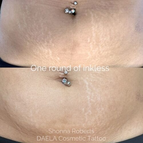 Inkless scar and stretch mark treatments