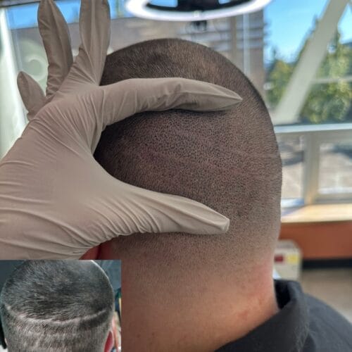Cover Hair Transplant Scars with SMP at DAELA Cosmetic Tattoo