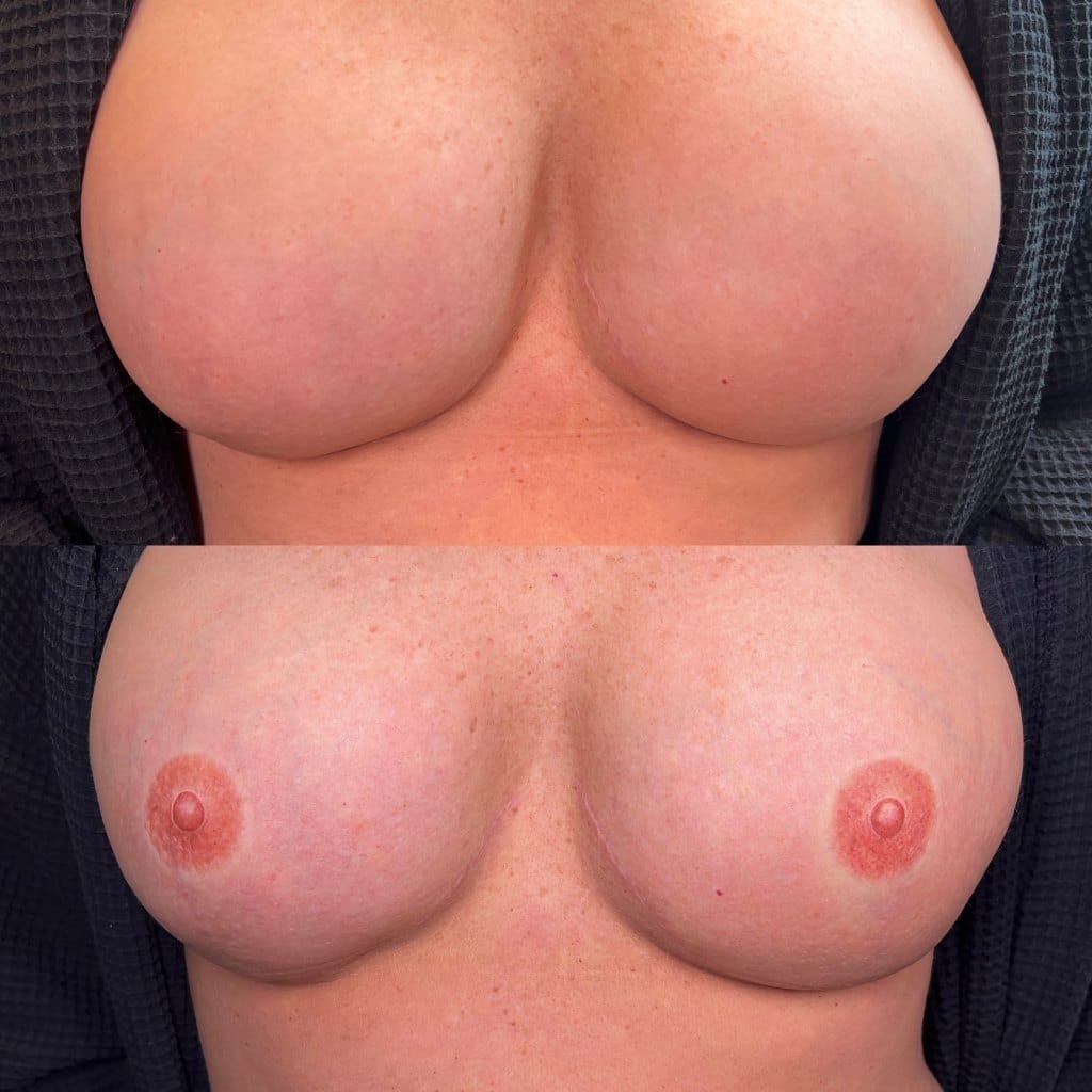 3D Areola Restoration Tattoo Training at DAELA Cosmetic Tattoo