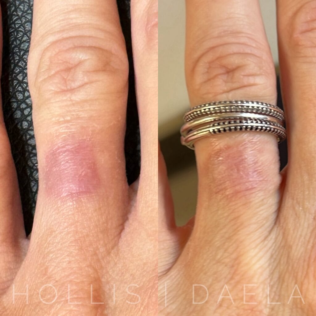 Scar Camouflage in Scottsdale at DAELA