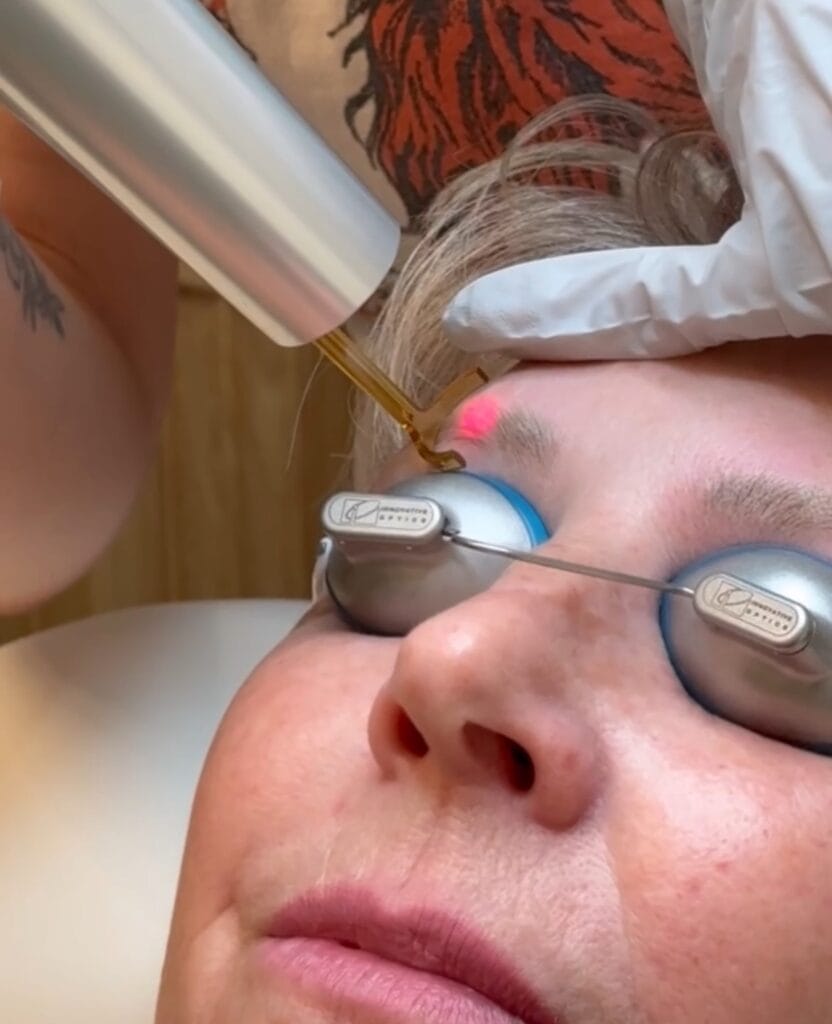 Microneedling + Laser Tattoo Removal Equals Amazing Skin