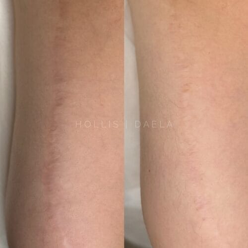 Inkless tattooing Serum Treatments at DAELA Scottsdale