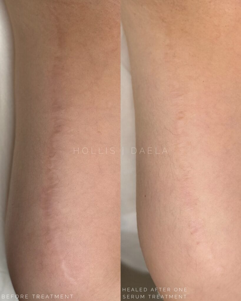 Inkless tattooing Serum Treatments at DAELA Scottsdale