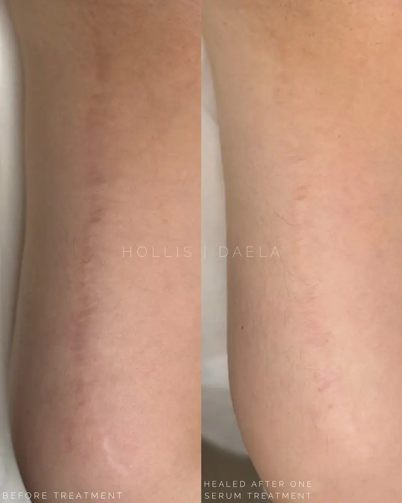 glutathione stretch marks Gluta Master Remover Anti Scar Oil with Collagen Clarify Skin How Gluta white whitening lotion