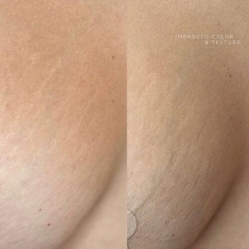 Inkless Tattooing: Serum Treatments for Scars and Stretchmarks