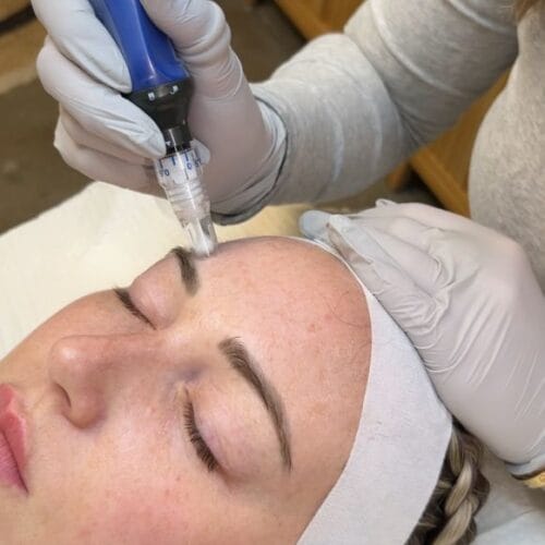 Microneedling at Daela Cosmetic Tattoo in Portland Oregon