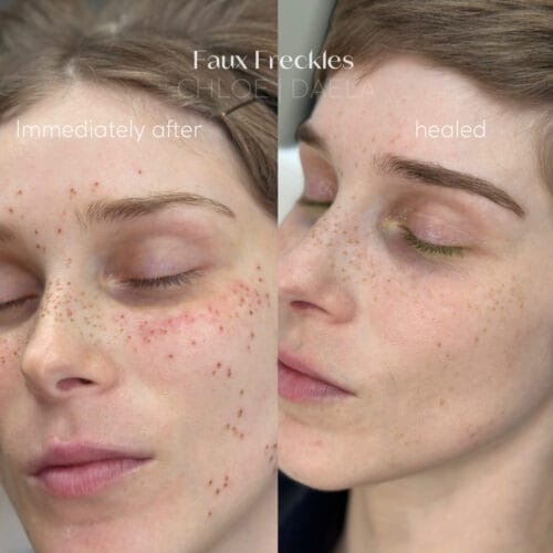 Fresh and healed faux freckles at DAELA scottsdale