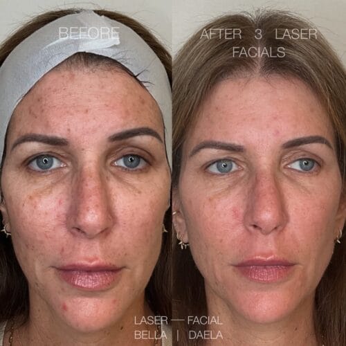 Hot Take: Laser Skin Treatments + Scottsdale Summer 