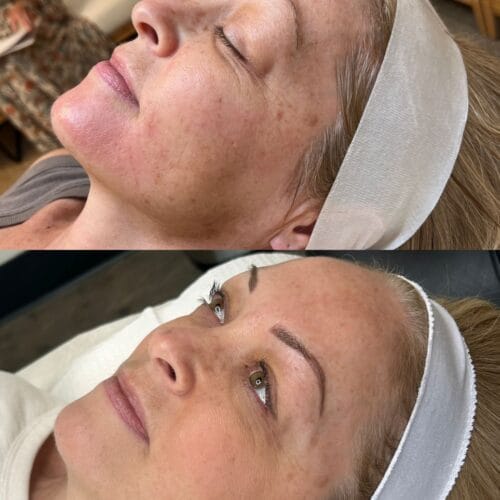 Laser Skin Treatment at Daela Cosmetic Tattoo in Portland