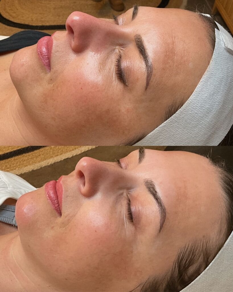 Laser Skin Treatments at Daela Cosmetic Tattoo in Portland Oregon