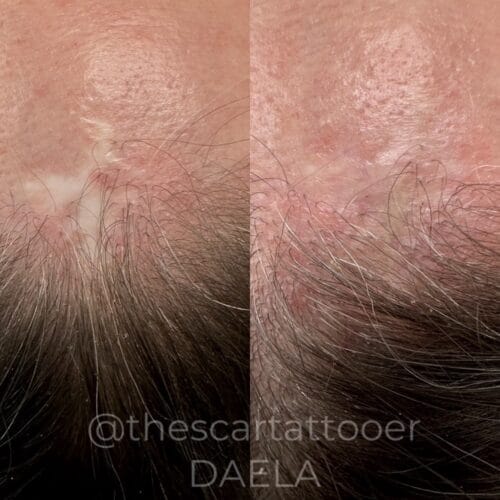 How Scar Camouflage Restores Confidence After Skin Cancer Scarring