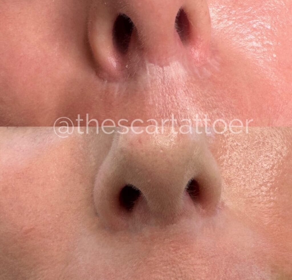 Scar Camouflage Tattooing Helps Conceal Lip Lift Scars