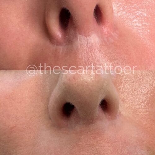 Scar Camouflage Tattooing Helps Conceal Lip Lift Scars