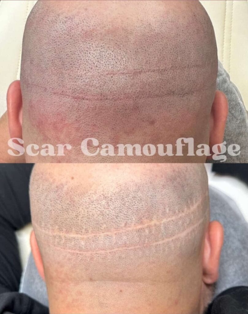 scar camo for hair transplant scars at DAELA