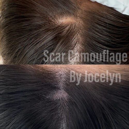 SMP for Scalp Scars