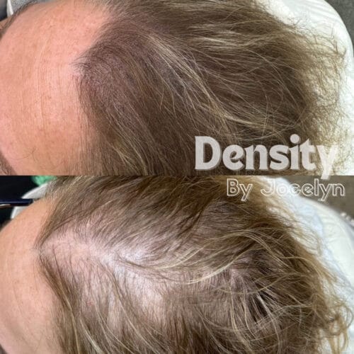 SMP for Women's hair Density at DAELA