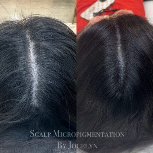 SMP for Women's hair Density at DAELA