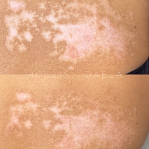 Scar Camouflage in Scottsdale at DAELA