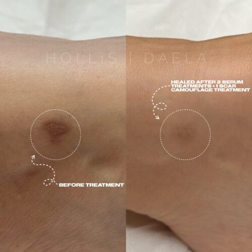 Scar camouflage at DAELA Scottsdale