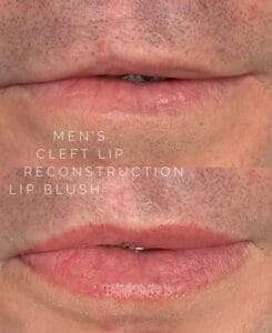 Dynamic Duo: Lip Blush Tattoo and Scar Camouflage to Disguise Cleft Lip Scars