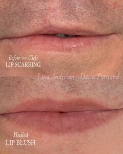 Dynamic Duo: Lip Blush Tattoo and Scar Camouflage to Disguise Cleft Lip Scars