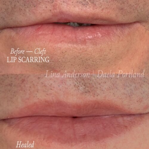 Cleft Lip Camouflage DAELA Cosmetic Tattoo
