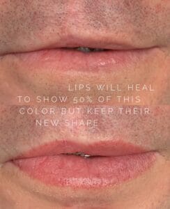 Dynamic Duo: Lip Blush Tattoo and Scar Camouflage to Disguise Cleft Lip Scars