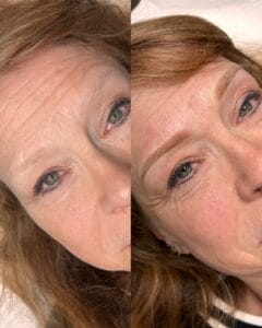 New Brows After laser Removal at DAELA