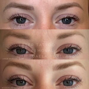 Permanent Makeup Removal at DAELA
