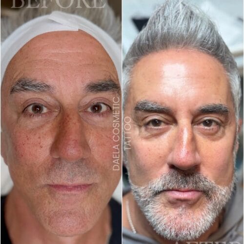 Laser Skin Treatments for Men: Brown Spot Removal