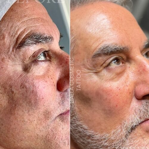 Brown Spot Removal with Pico Way at DAELA Cosmetic Tattoo