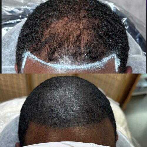 Thinning Hair: Combining SMP and PRF at DAELA