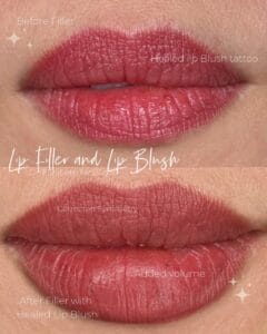 What’s Trending for Fillers in 2026