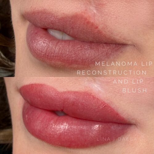 Melanoma Scarring and the Reconstructive Power of Lip Blush Tattoo