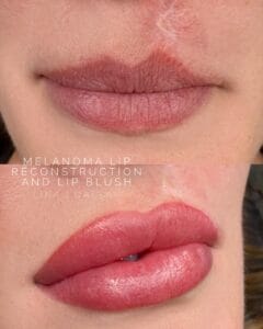 Melanoma Scarring and the Reconstructive Power of Lip Blush Tattoo