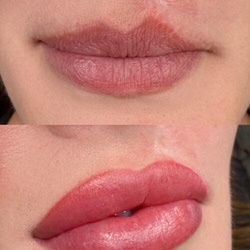 Lip Blush After Melanoma Surgery