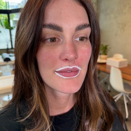 Lip Blush After Melanoma Surgery