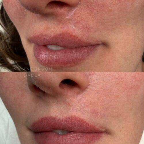 Lip Blush After Melanoma Surgery