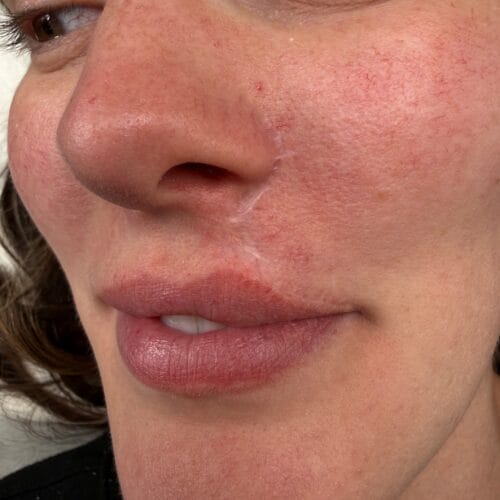 Lip Blush After Melanoma Surgery