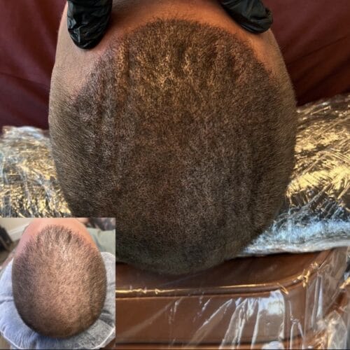 How Scalp Micropigmentation Creates the Look of Fuller Hair for Men