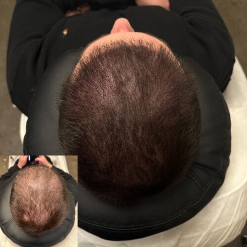 How Scalp Micropigmentation Creates the Look of Fuller Hair for Men