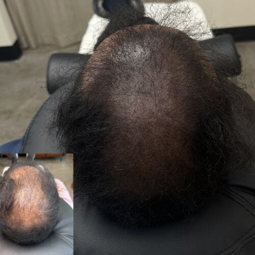 How Scalp Micropigmentation Creates the Look of Fuller Hair for Men
