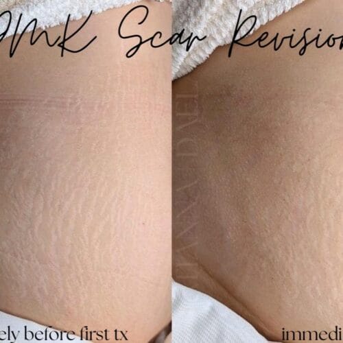 DMK Scar Treatment at DAELA Scottsdale