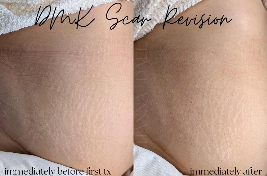 DMK Scar Treatment at DAELA Scottsdale